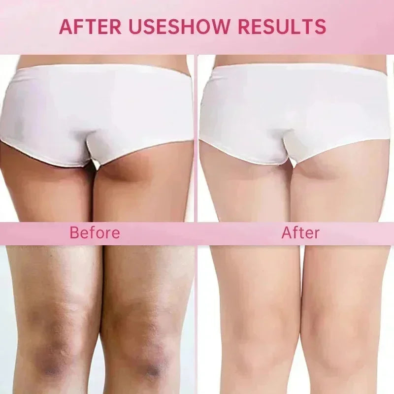 Whitening Cream Private Parts Underarm Bleaching Serum Whiten Butt Knee Brighten Inner Thigh Intimate Parts Dark Remove Melanin